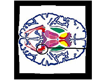 Deformable Brain Atlas - 1
